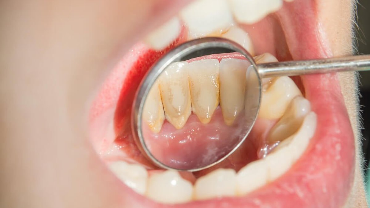 C mo Eliminar El Sarro De Los Dientes Con Remedios Caseros